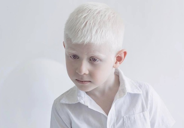 Дети-альбиносы: дар или несчастье?