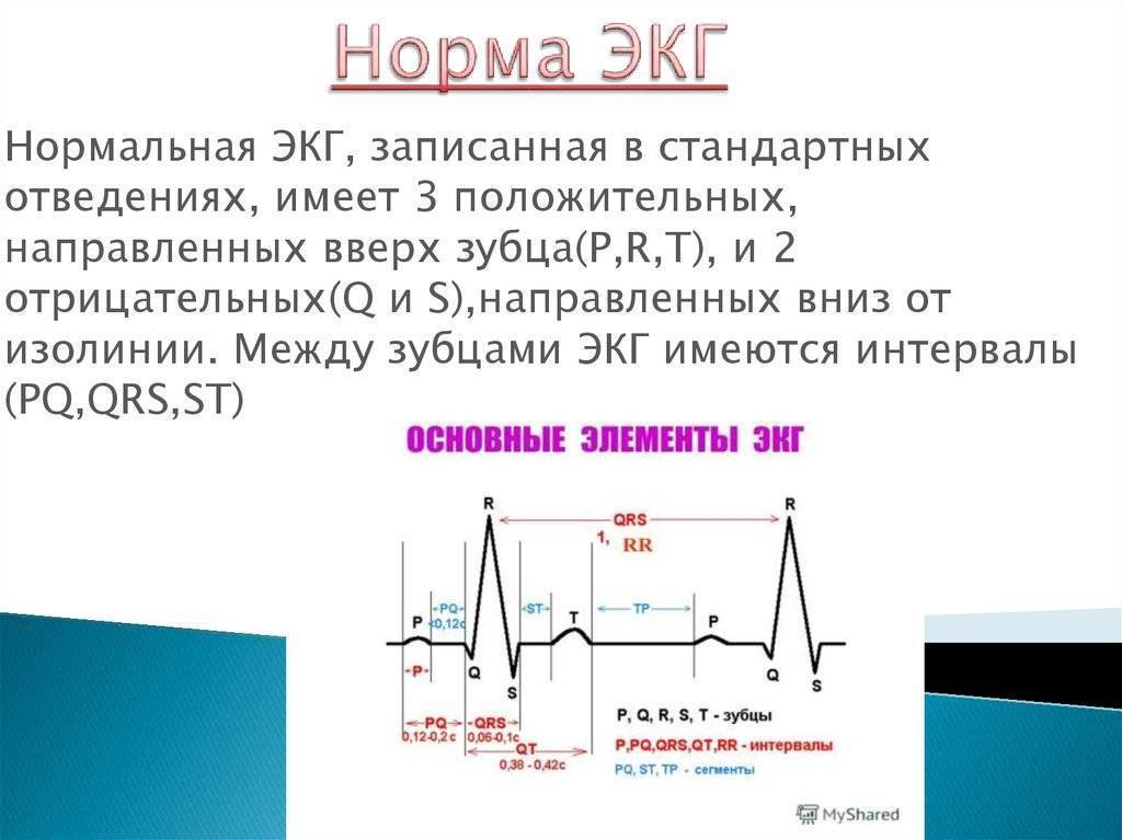 Экг в норме фото с описанием и схемами