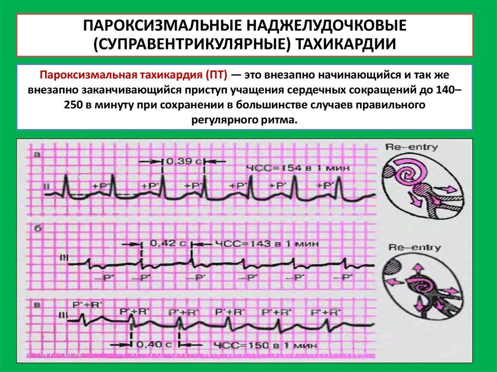 Синусовая тахикардия сердца: лечение у ребенка и причины
