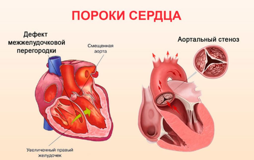 Врожденные пороки сердца у детей и взрослых: симптомы, лечение | врожденные пороки сердца у новорожденных.
