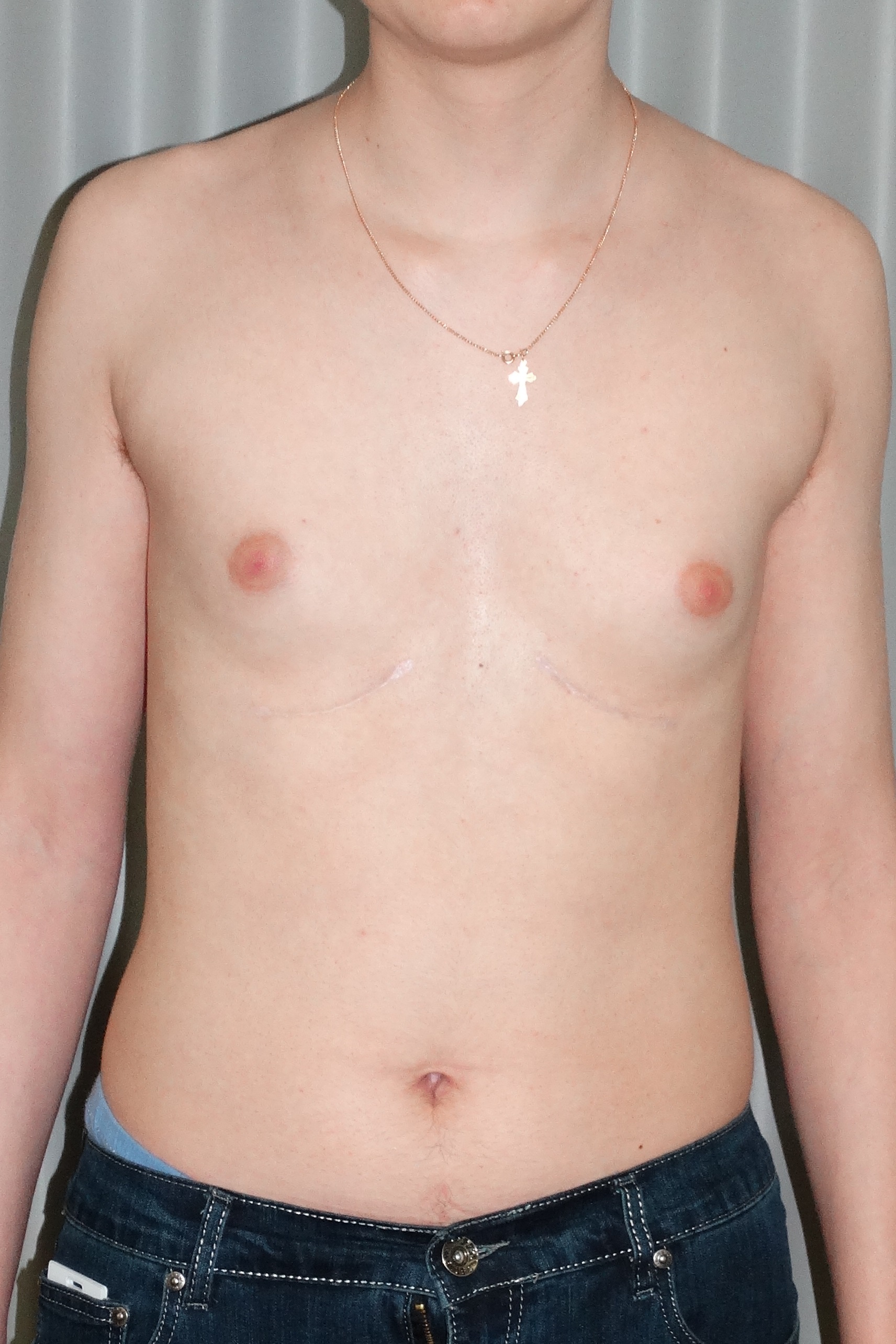 воронкообразная грудь у женщин фото 112
