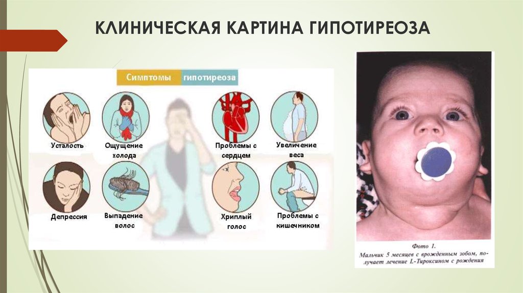 Врожденный гипотиреоз у детей