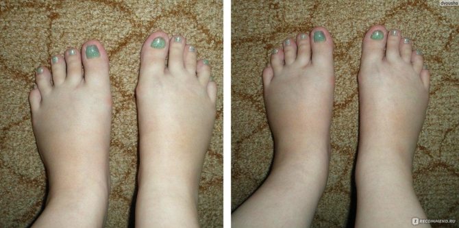 Варикоз нижних конечностей: лечение, причины и симптомы варикозного расширения вен ног