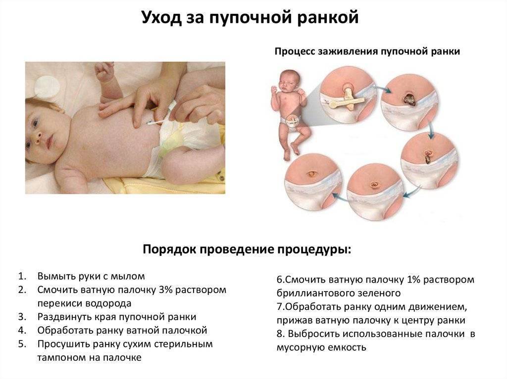 Инструкция по уходу и обработке пупка у младенца