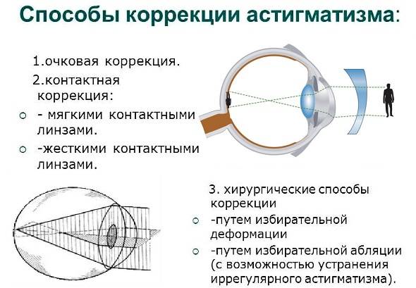 Причины и лечение астигматизма у детей
