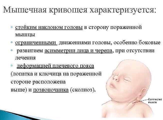 Что такое кривошея у новорожденного ребенка и детей до года: признаки, симптомы, причины, лечение в домашних условиях, комплекс упражнений