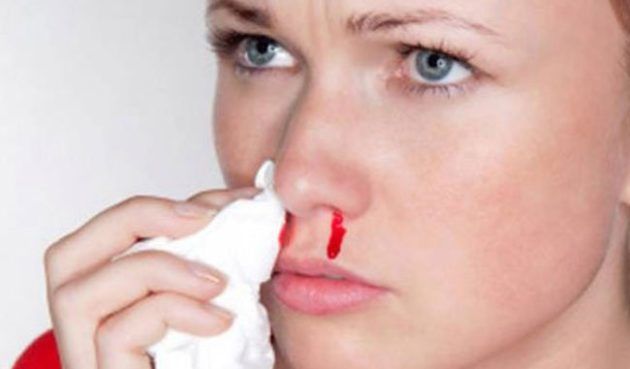 Частое носовое кровотечение у взрослых и детей причины, лечение