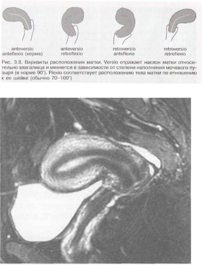 Антеверзио и антефлексио матки. Положение матки anteflexio.