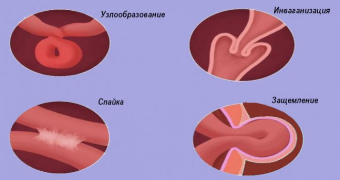 Инвагинация клиническая картина