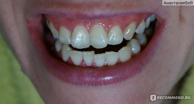 Композитная реставрация зубов - реставрация зубов композитным материалом: цена, фото до и после