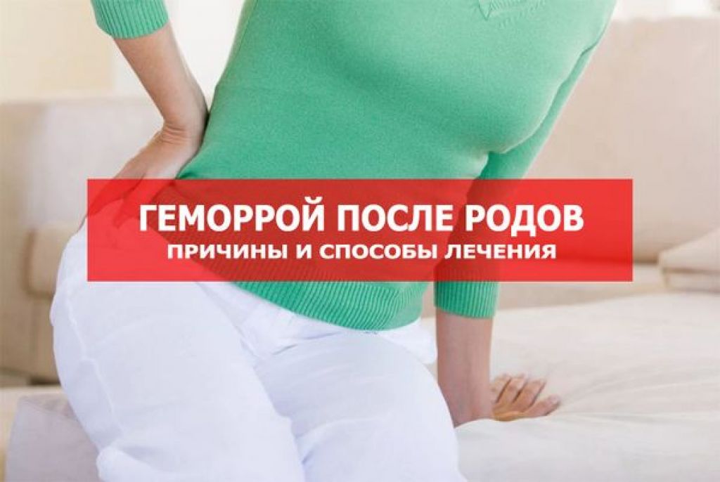 Лечение геморроя