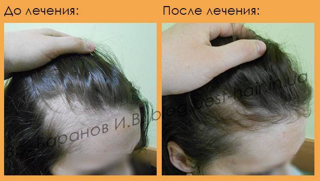 Выпадение волос после родов, как убрать залысины и причины их появления