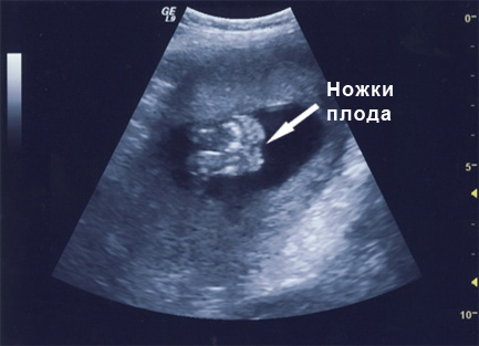 3 недели беременности после эко