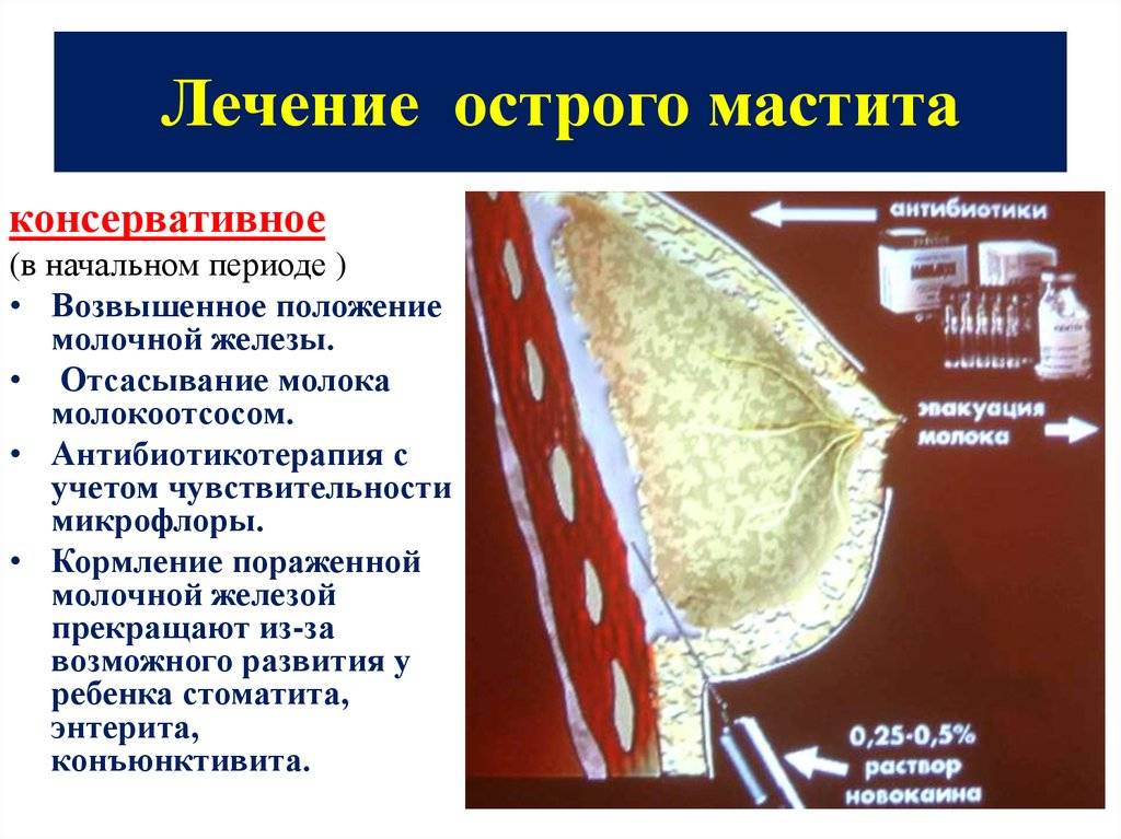Лактационный мастит у кормящей мамы: симптомы и лечение