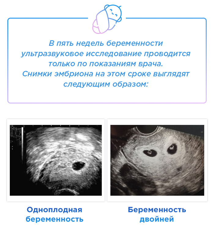 Что будет через 5 недель. Как выглядит эмбрион в 5-6 недель на УЗИ. Размер плода по УЗИ 5 недель. Беременность 5 недель УЗИ признаки. Эмбрион на 5 неделе беременности УЗИ.