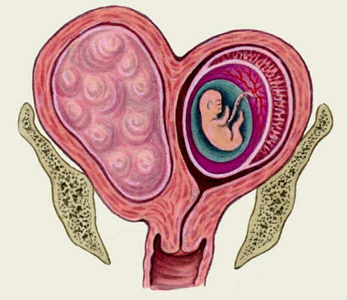 Миома матки и беременность - причины, диагностика и лечение