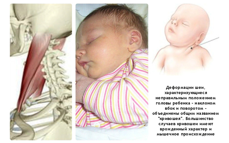 Кривошея у младенцев: признаки, лечение, видео массажа