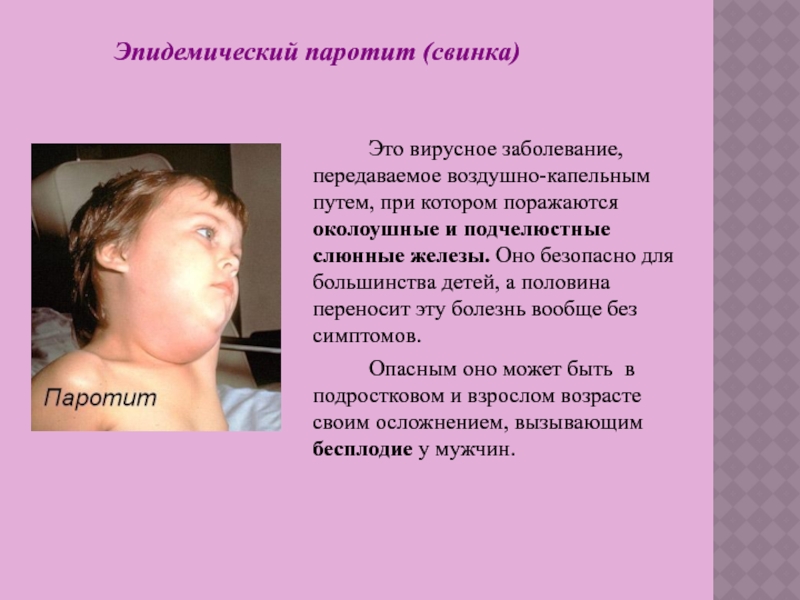 Эпидемический паротит