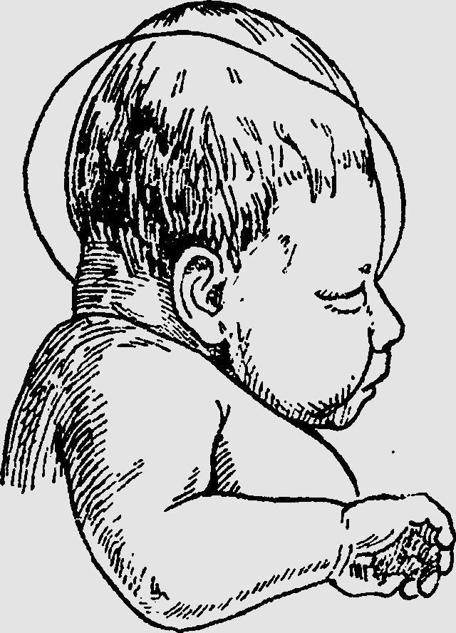 Затылок ребенка. Кефалогематома у новорожденного. Кефалогематома пункция. Затылочная кефалогематома. Долихоцефалическая, долихоцефалическая форма головы.
