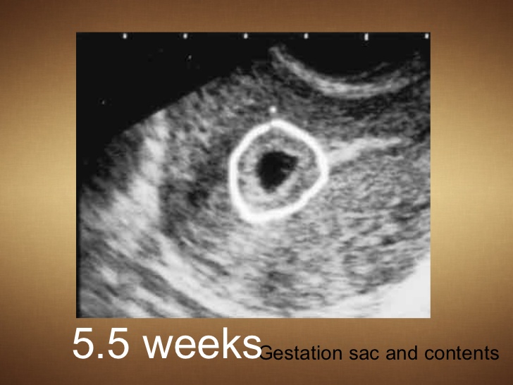 Цвет сосков на раннем сроке. Внематочная беременность на УЗИ. Внематочная на УЗИ 5 недель. Внематочная беременность фото. Внематочная беременность на УЗИ фото.