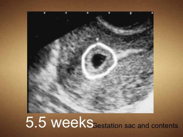 Внематочная 6 недель. Внематочная беременность на УЗИ. Внематочная на УЗИ 5 недель. Внематочная беременность фото. Внематочная беременность на УЗИ фото.