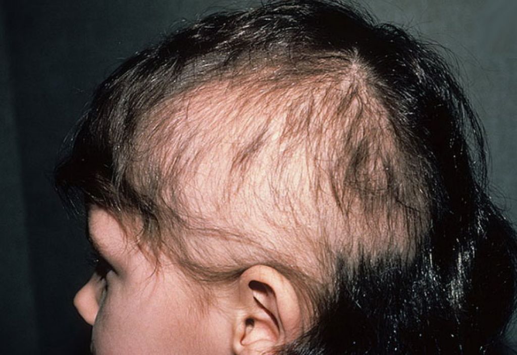 К кому обращаться при выпадении волос у ребенка