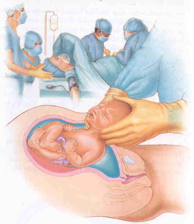 «ниши» рубца на матке после кесарева сечения: диагностика, лечение и исходы » библиотека врача