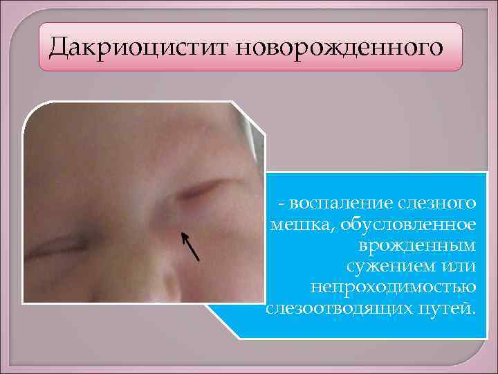Лечение дакриоцистита новорожденных - операция или массаж при дакриоцистите в москве: свао, метро отрадное, бибирево, владыкино