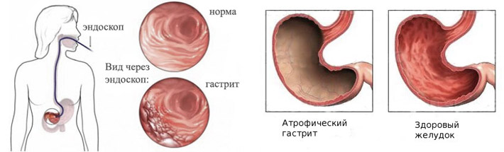 Форум атрофическим гастритом желудка. Поверхностный и атрофический гастрит.
