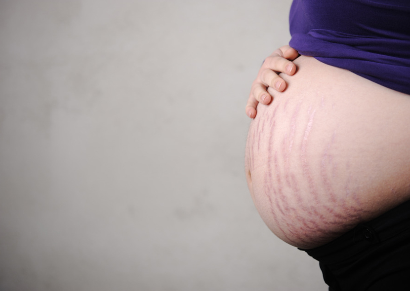 Трещина после родов. Растяжки беременных на животе.