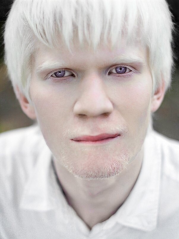 Альбинизм — википедия