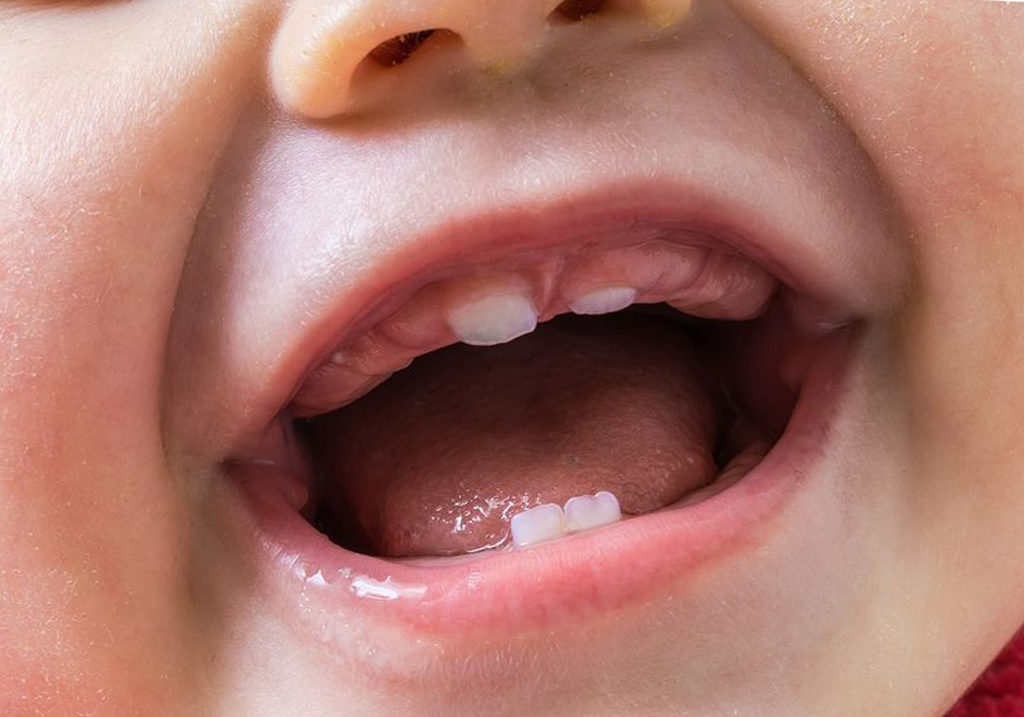 Пульпит молочных зубов у детей, как обнаружить и лечение