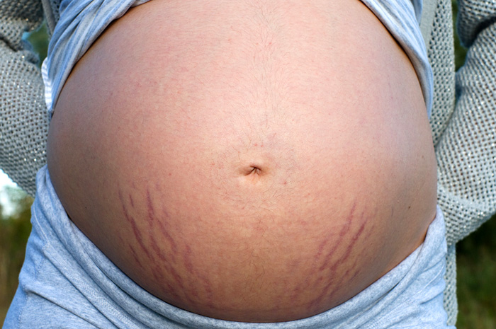 Растяжки после беременности, и как от них избавиться