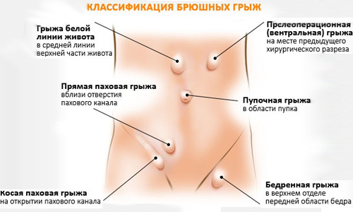 Особенности проявления паховой грыжи в детском возрасте