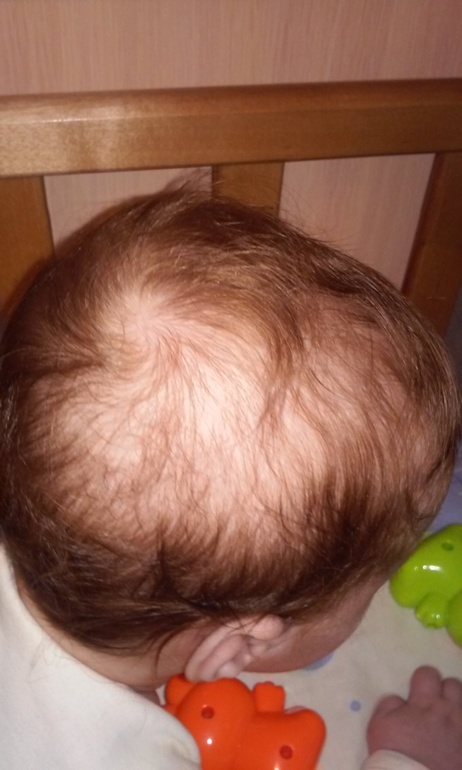 Почему у новорожденного выпадают волосы на голове комаровский