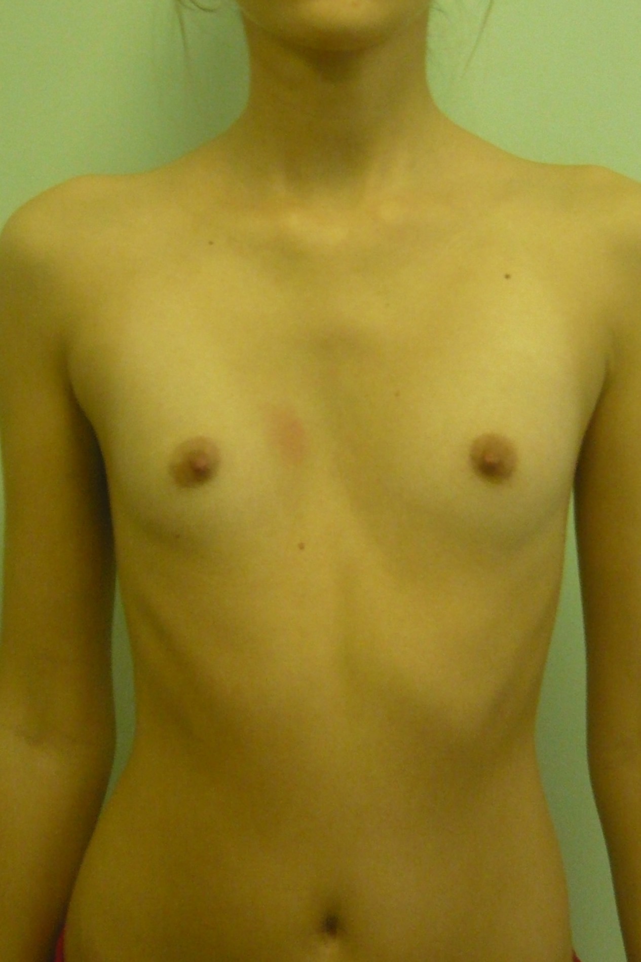воронкообразная грудь у женщин фото 7