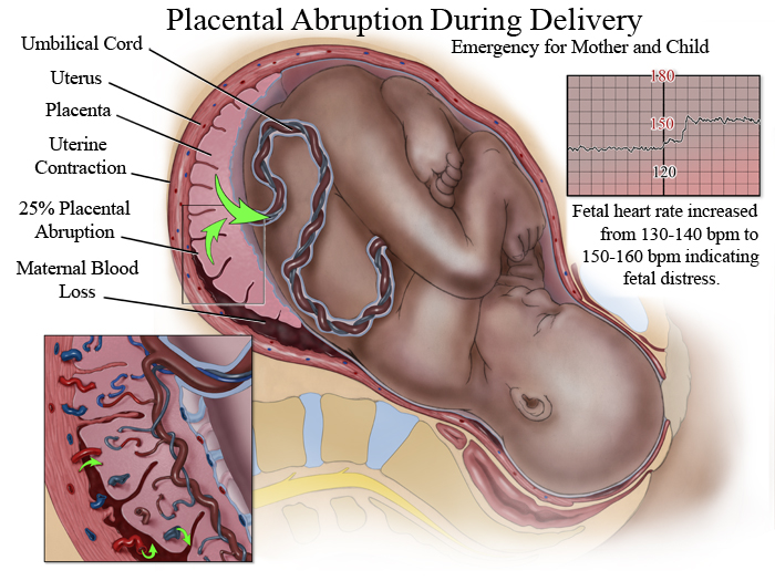 Выделения на ранних сроках беременности | eurolab | гинекология
