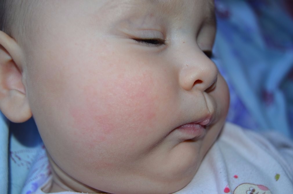 Диатез на щеках у ребенка: лечение, советы комаровского
