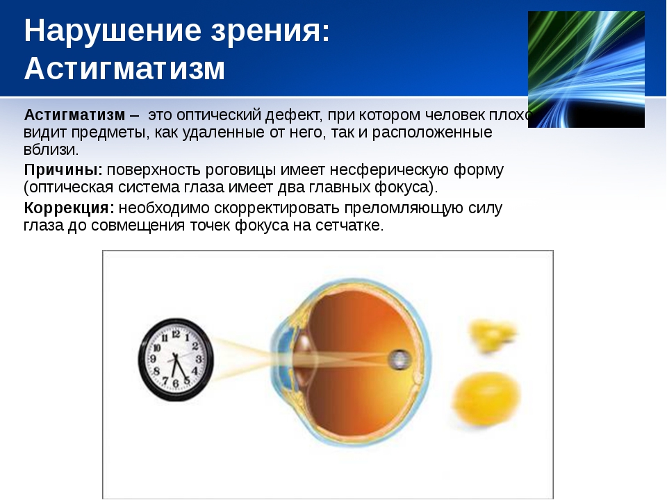 Близорукость дальнозоркость астигматизм презентация