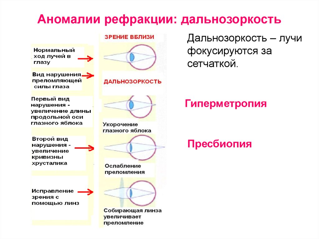 Какие из рисунков соответствуют дальнозоркому глазу