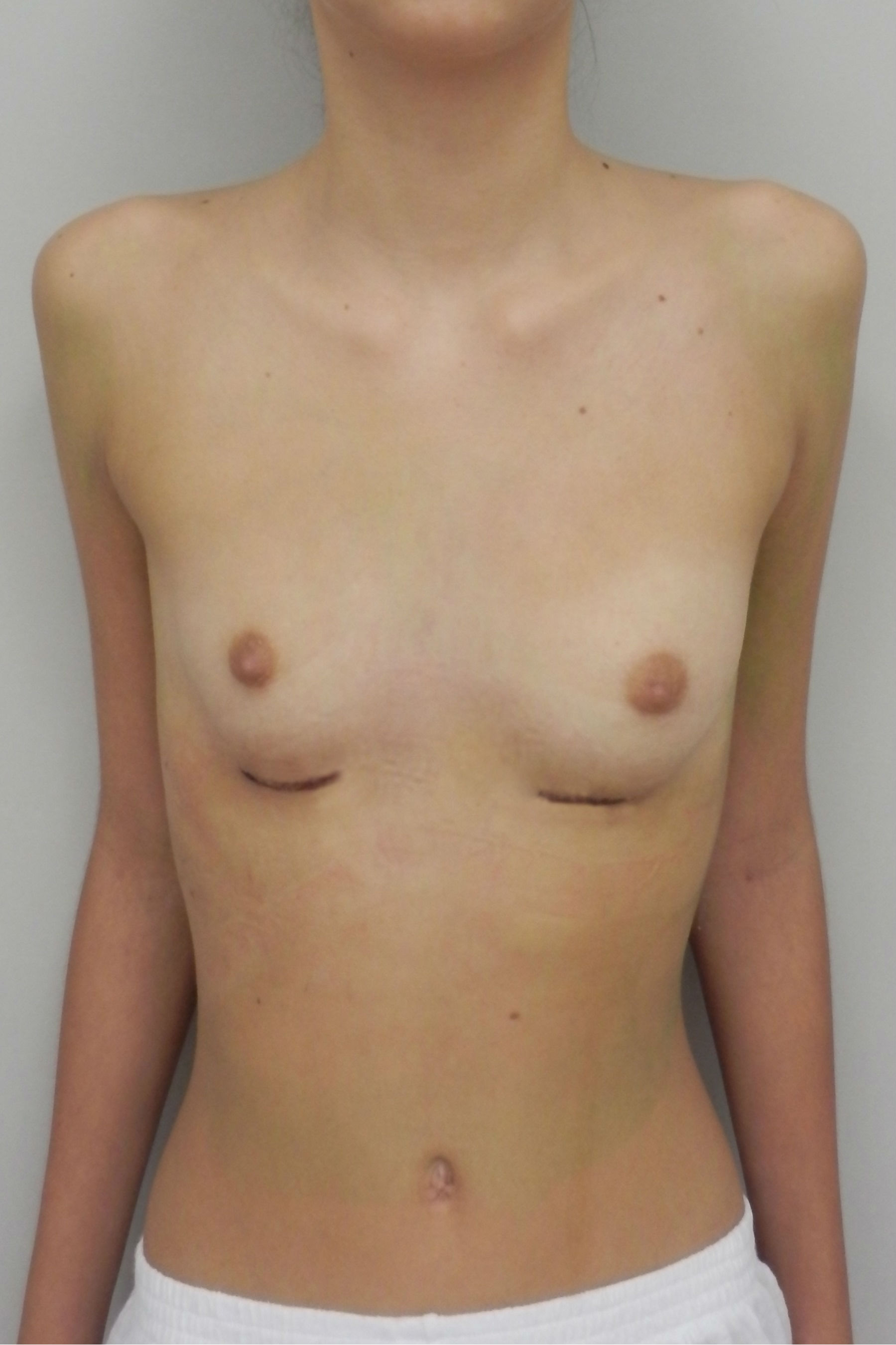 воронкообразная грудь у мужчин фото 59