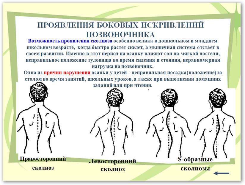 Искривление позвоночника 5. Выявление признаков сколиоза у детей. Профилактика искривления позвоночника. Нарушения осанки и деформации позвоночника у детей. Профилактика искривления позвоночника у детей.