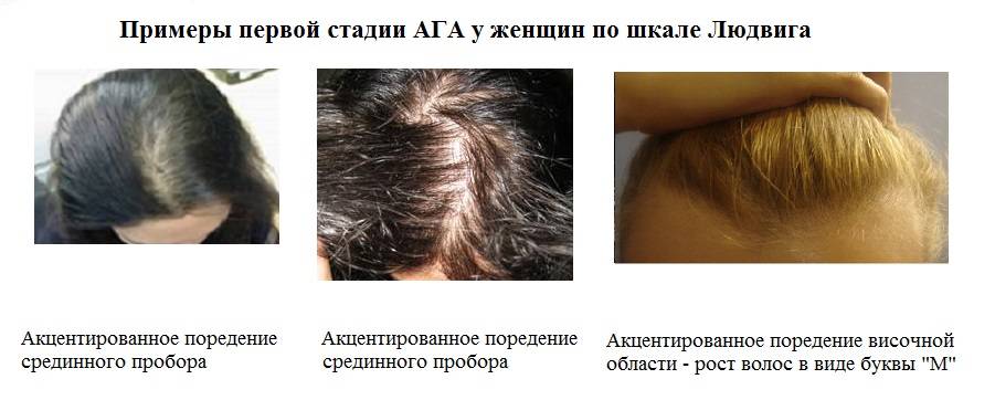 Почему после коронавируса выпадают волосы