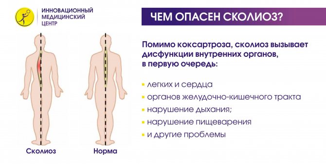 Сколиоз позвоночника у взрослых 1-2 степени лечение, диагностика