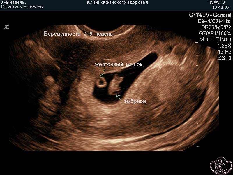 Аборт на 7 неделе беременности