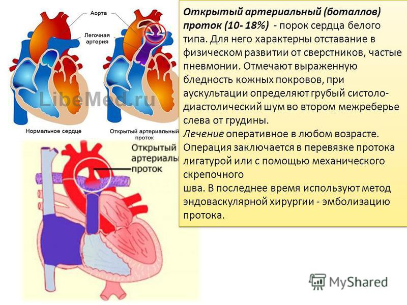 Врожденный порок сердца у новорожденных: симптомы, лечение