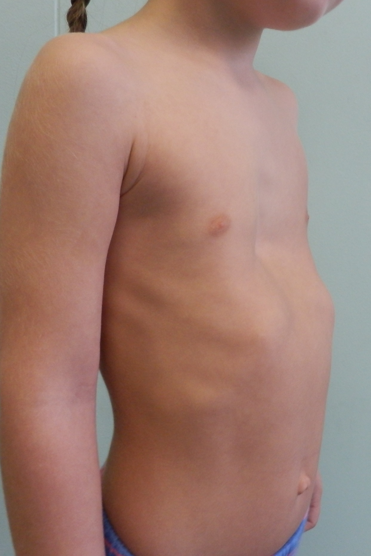 воронкообразная грудь у мужчин фото 88