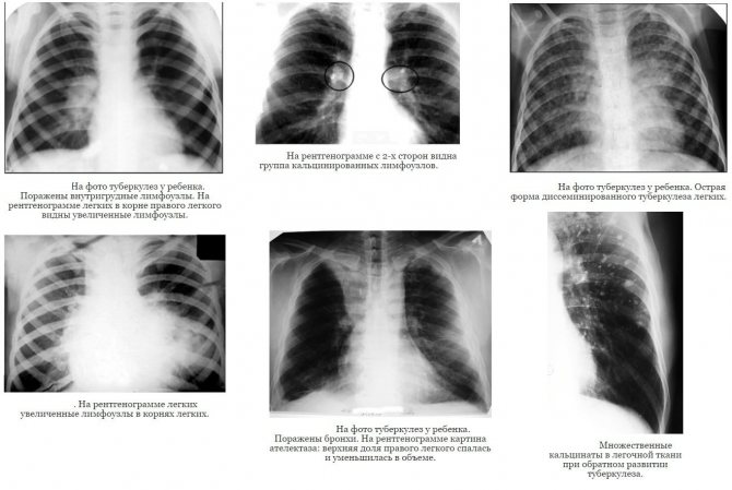 Туберкулез у новорожденных и дошкольников от 3 до 7 лет: признаки и первые симптомы