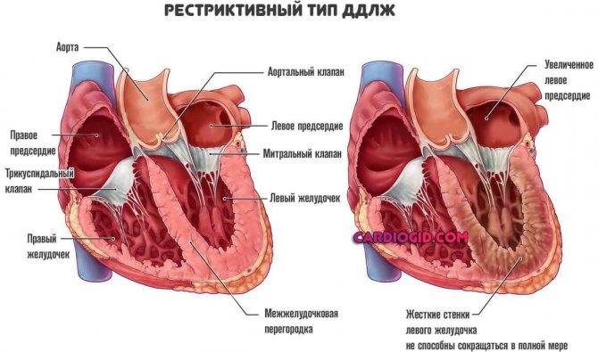 Открытый артериальный проток - лечение в отделении института амосова.