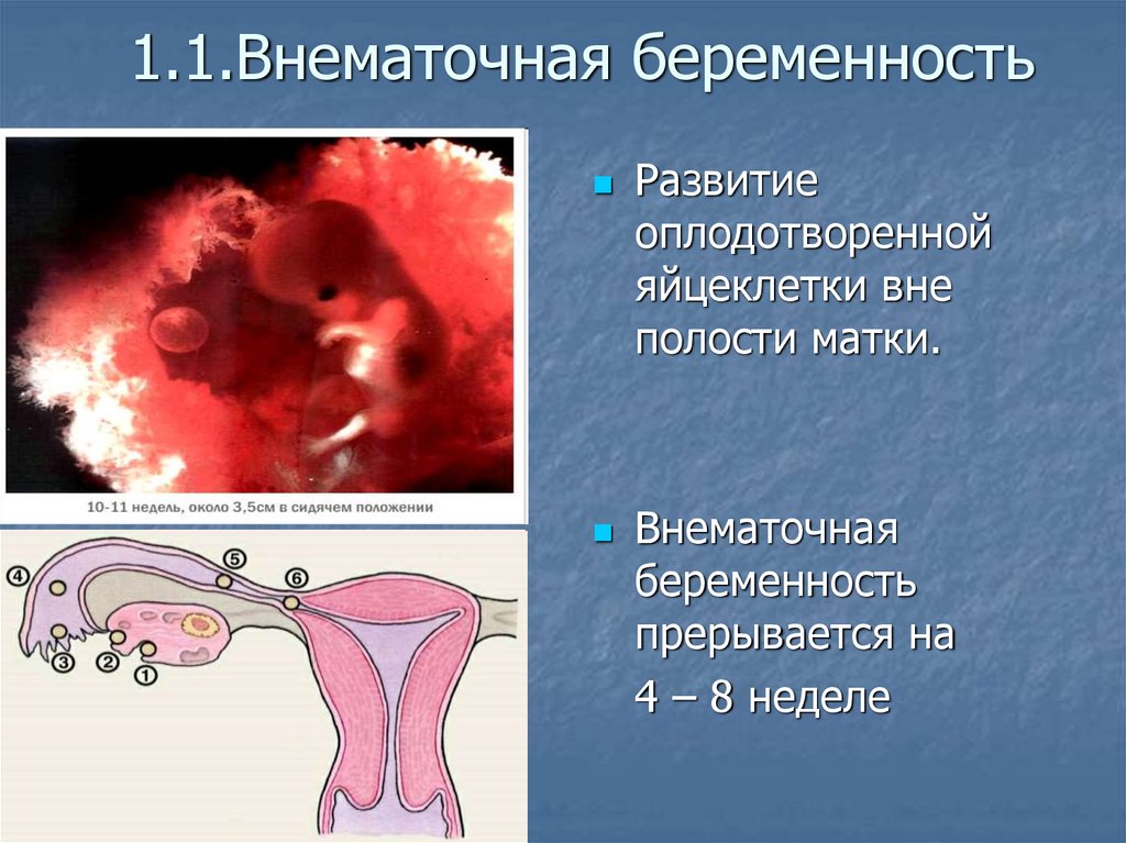 Внематочная беременность - симптомы болезни, профилактика и лечение внематочной беременности, причины заболевания и его диагностика на eurolab